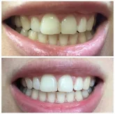 Студия косметического отбеливания зубов White&Smile фото 5